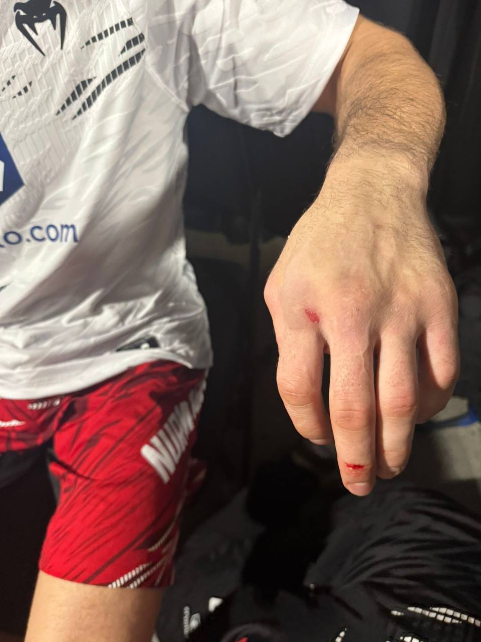 Рука Умара Нурмагомедова после поражения от Мераба Двалишвили на UFC 311