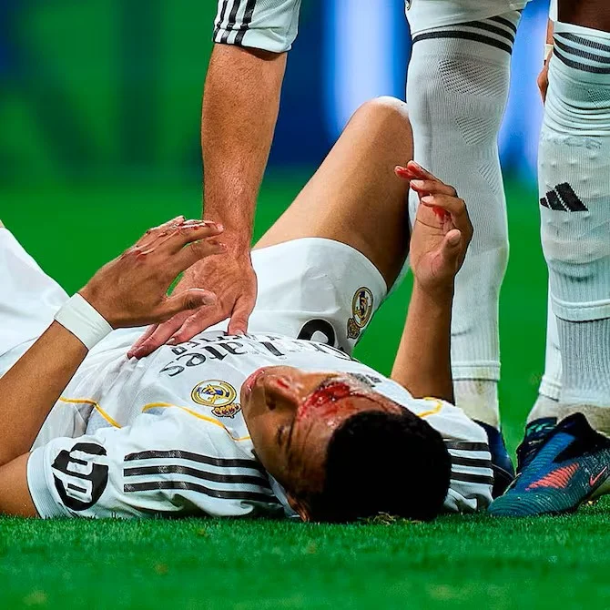 Килиану Мбаппе разбили лицо в матче с «Жироной». Фото: onefootball.com